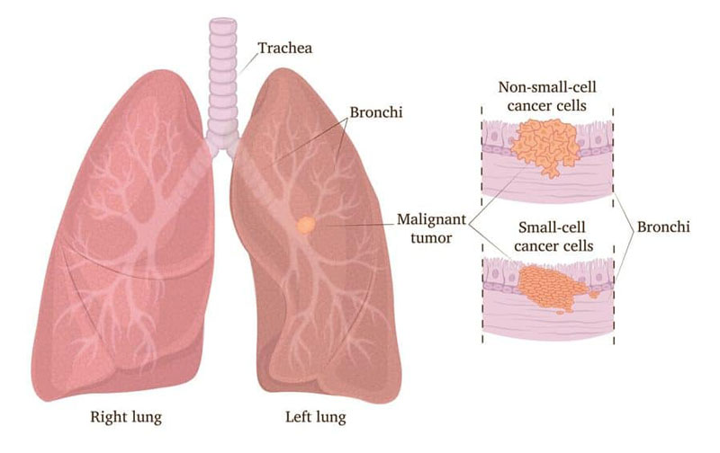 Hiện tượng đột biến gen thường xảy ra ở bệnh nhân ung thư phổi không tế bào nhỏ
