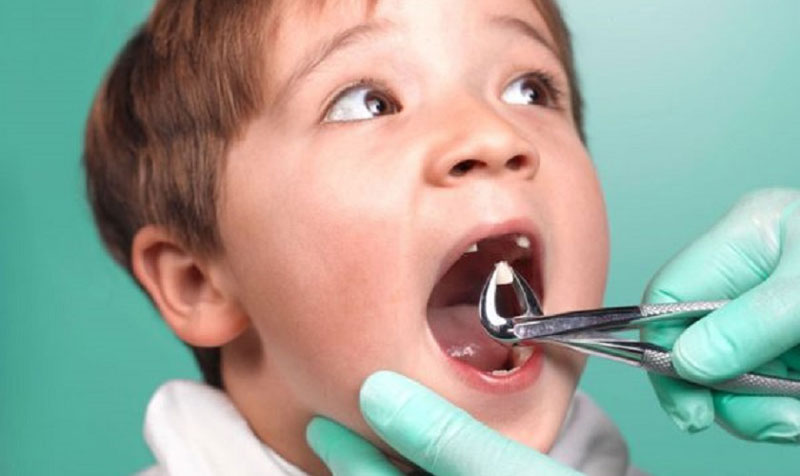 Chỉ nên can thiệp nhổ răng sữa khi trẻ đã đến tuổi thay răng nhưng chưa lung lay