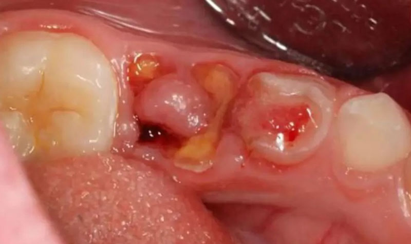 Loại bỏ hoàn toàn chân răng đối với ổ viêm nặng hoặc tỷ lệ lây lan cao