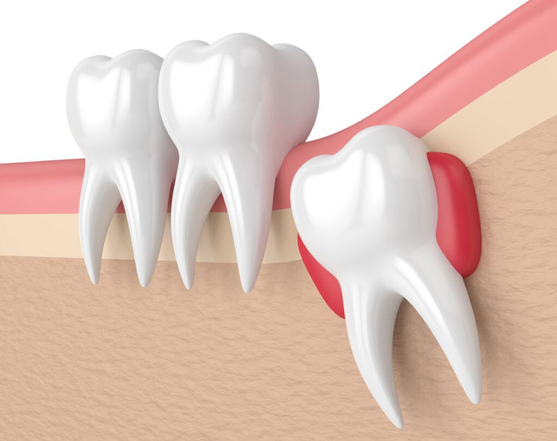 Bạn nên đi nhổ nếu răng khôn mọc lệch, ảnh hưởng tới cấu trúc hàm răng