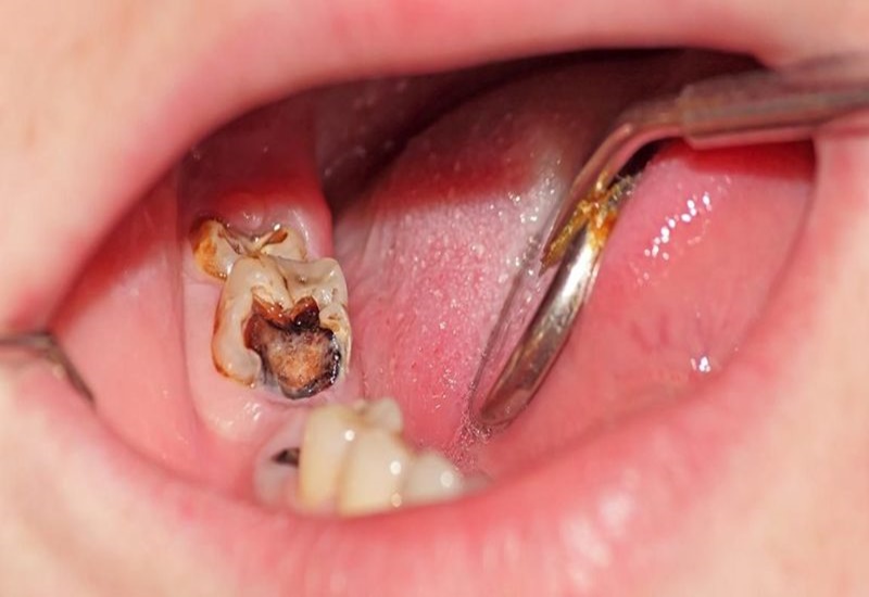 Khi răng bị sâu quá nghiêm trọng thì cần nhổ bỏ