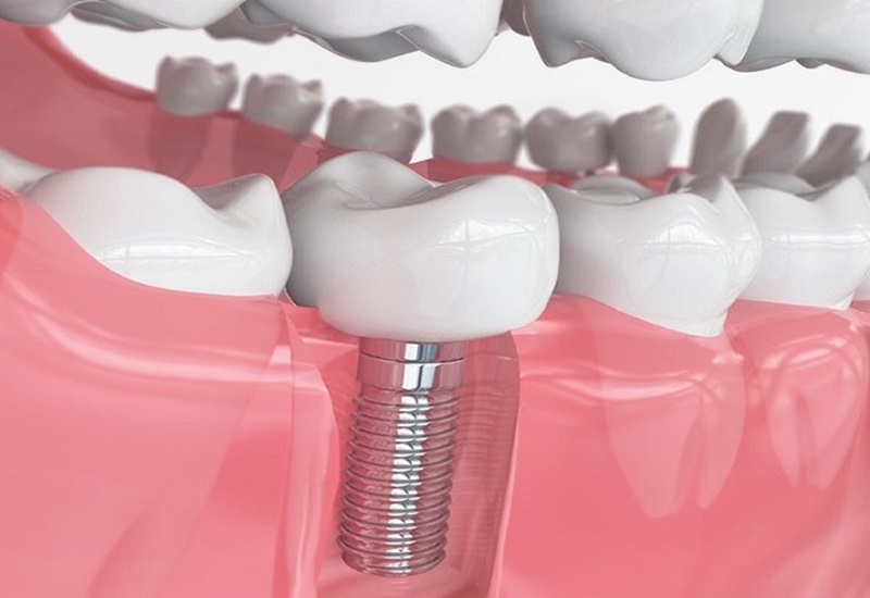 Trồng răng implant được nhiều khách hàng ưa chuộng.
