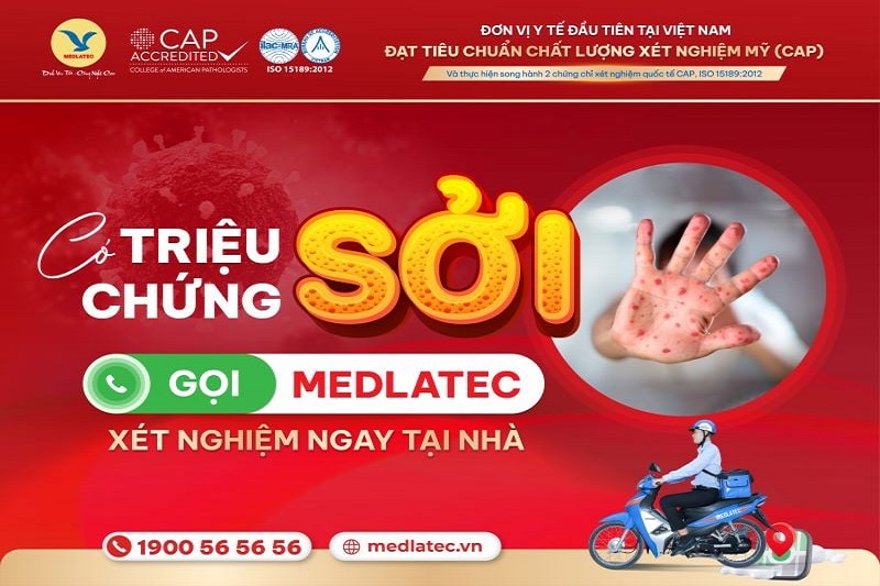 MEDLATEC xét nghiệm chẩn đoán bệnh Sởi nhanh chóng, chính xác