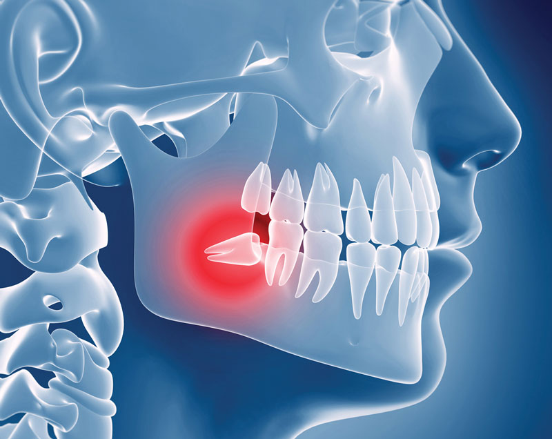 Có nhiều nguyên nhân nào khiến răng khôn bị mọc lệch