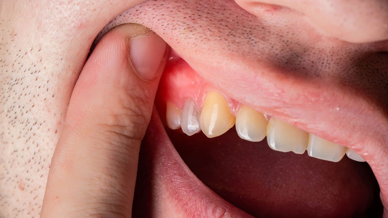 Sưng lợi là biến chứng thường gặp ở bệnh nhân có răng khôn mọc lệch