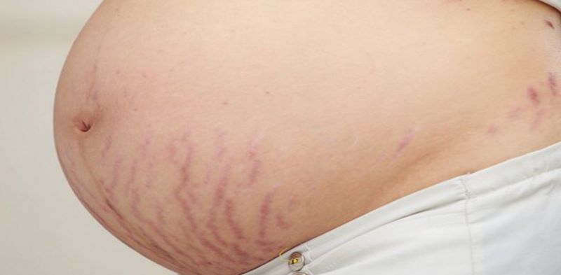 Những vết rạn trên da khiến nhiều mẹ bầu trở nên tự ti, mặc cảm
