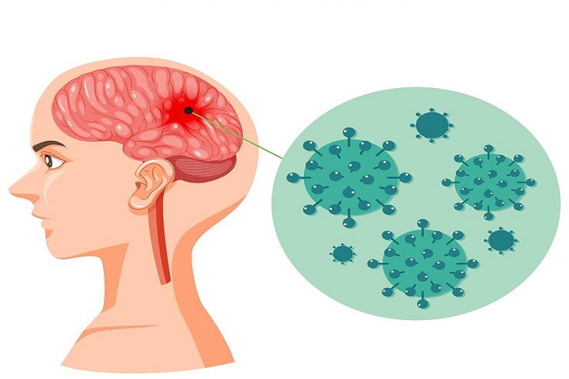 Viêm não biến chứng do bệnh sởi có thể gây nguy hiểm cho sự sống của người bệnh