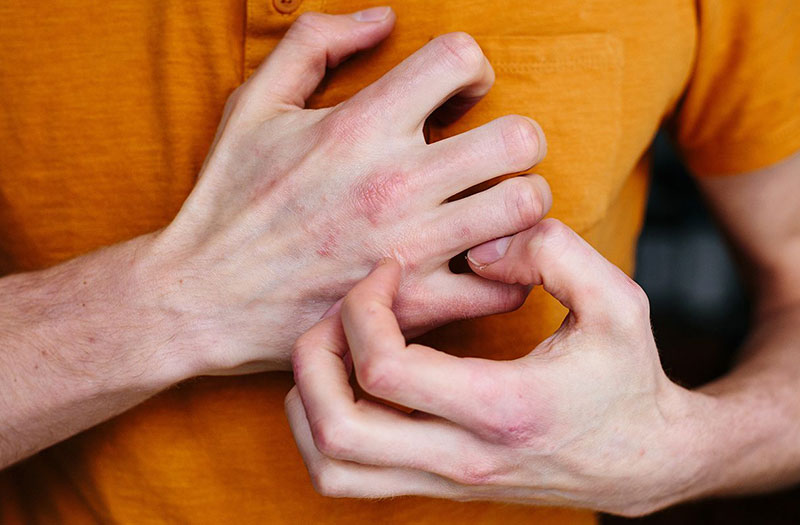  Ngứa lòng bàn tay khi trời lạnh : Nguyên nhân và cách điều trị hiệu quả