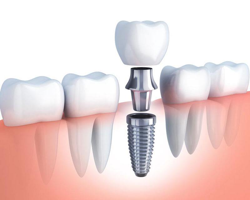 Chi phí trồng răng giả cố định Implant tương đối cao