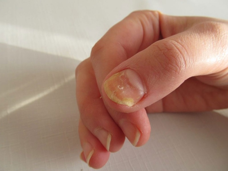 M&oacute;ng tay bị l&otilde;m l&agrave; g&igrave;, l&agrave;m sao để khắc phục?