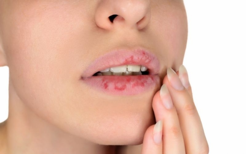Bệnh bệnh chàm môi là gì - Triệu chứng, nguyên nhân và cách điều trị