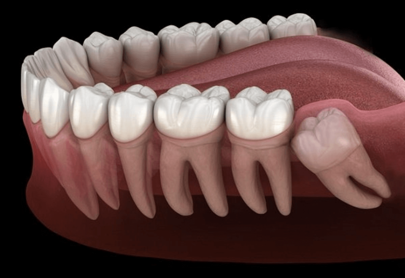 Răng khôn hàm dưới là răng hàm lớn thứ 3, xuất hiện ở vị trí cuối cùng của cung hàm