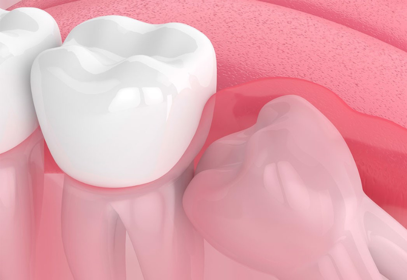 Nhổ răng khôn hàm dưới khi chúng tác động tiêu cực đến sức khỏe