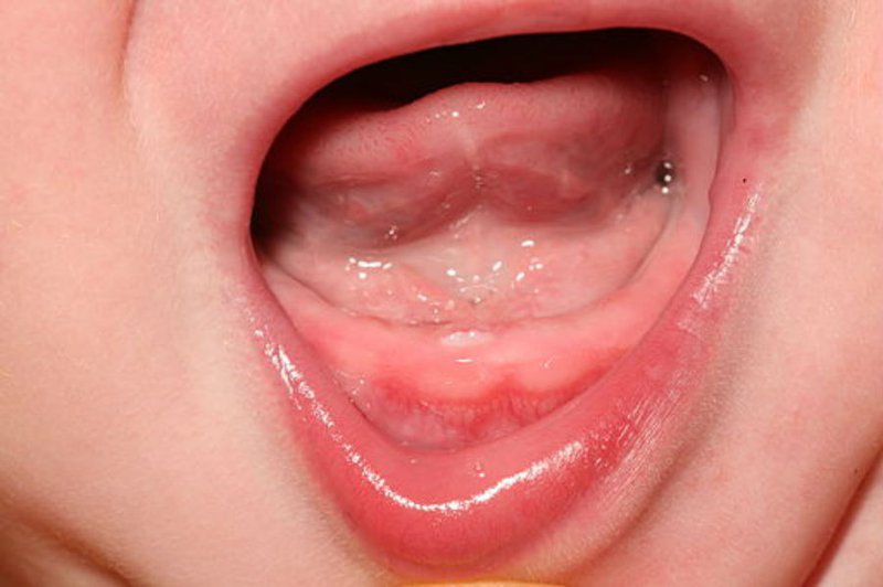 Viêm nướu là một trong các nguyên nhân khiến trẻ mọc răng sốt và đi ngoài