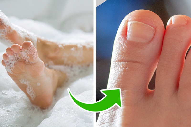 Móng chân bị sọc đen do tác động của ngoại lực cần được vệ sinh sạch sẽ hàng ngày, để cho móng tự bong tróc