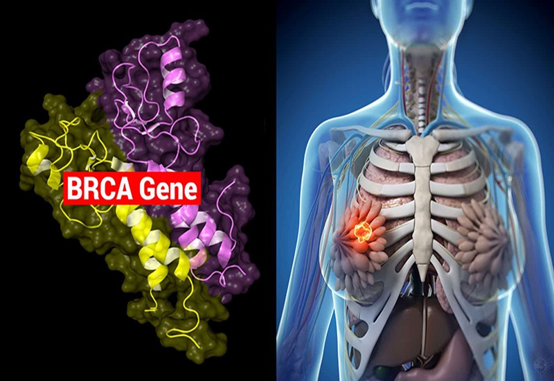 Ung thư vú có thể do đột biến gen