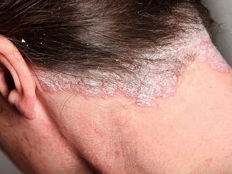 Bệnh vảy nến da đầu là gì? có lây không, chữa như thế nào?