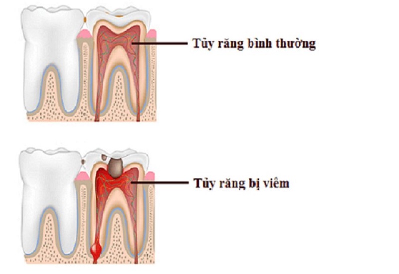 Tủy răng khi đã bị viêm thì cần điều trị càng sớm càng tốt