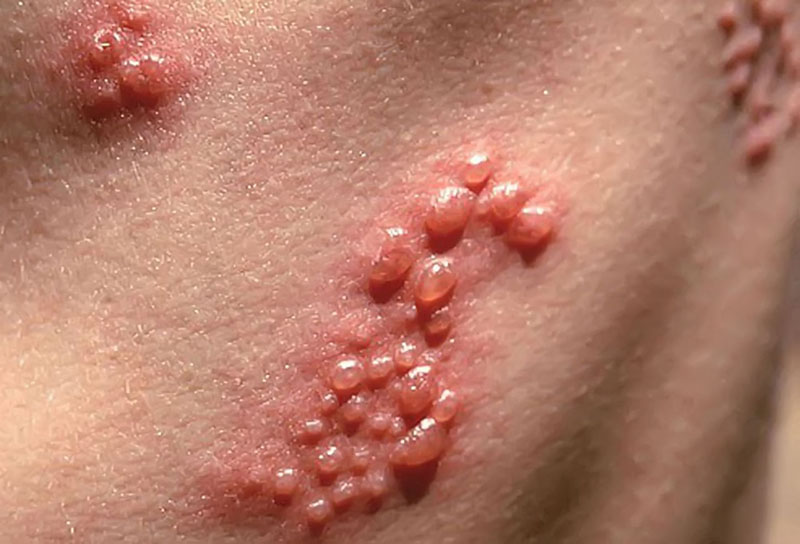 Nổi mụn rộp là dấu hiệu điển hình của Herpes sinh dục