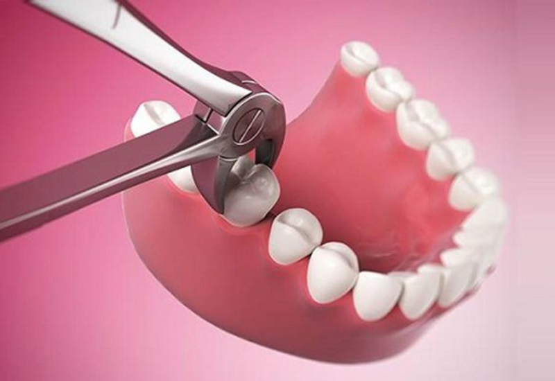 Những ca bệnh về răng 6 hàm dưới gây ảnh hưởng lớn đến sức khỏe bệnh nhân, bác sĩ sẽ đề nghị loại bỏ răng