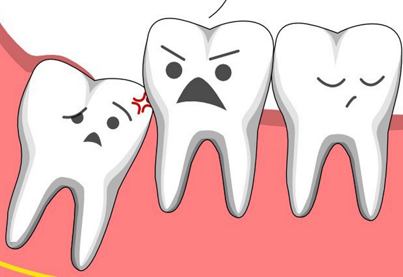 Răng 8 mọc không đúng là nguyên nhân khiến bạn phải chịu những cơn đau nhức răng dai dẳng