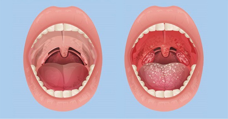 Viêm họng là một trong các nguyên nhân khiến bé bị viêm loét miệng họng sốt cao