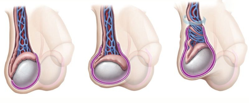 Xoắn tinh hoàn gây tắc nghẽn mạch máu, ngừng cung cấp máu đến tinh hoàn