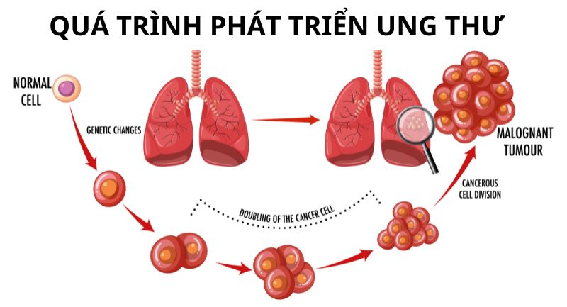 Ung thư phổi xảy ra trong các tế bào phổi. Đây là một trong những loại ung thư thường gặp nhất. 