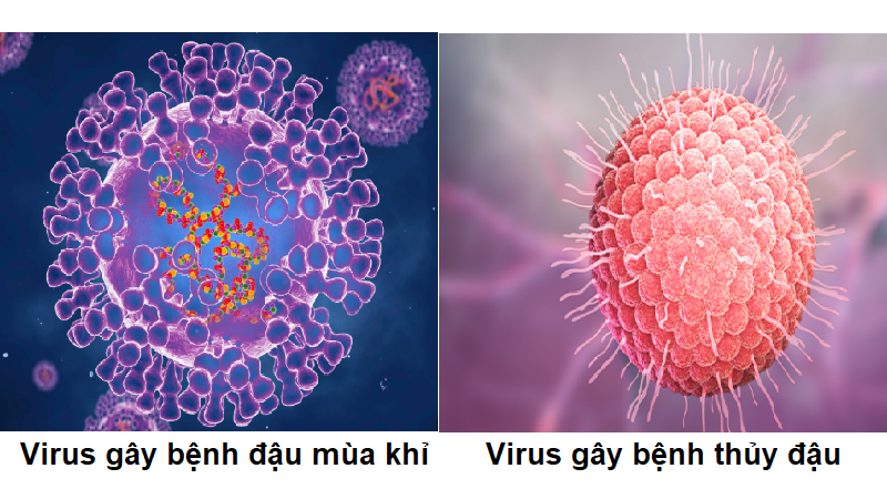 Đậu mùa khỉ và thủy đậu đều là bệnh gây nên bởi virus