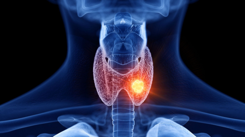 Ung thư tuyến giáp ảnh hưởng đến chức năng tuyến giáp và toàn bộ cơ thể