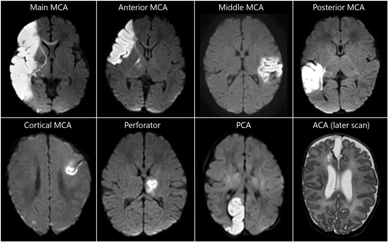 Chụp MRI giúp tầm soát hiệu quả đột quỵ thân não