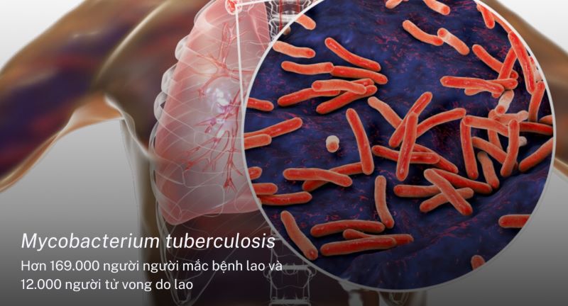 Mycobacterium Tuberculosis là tác nhân gây bệnh lao phổi