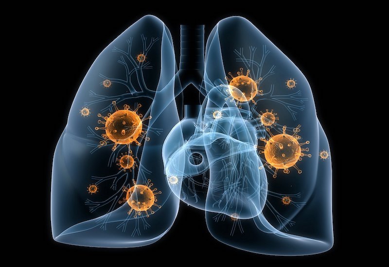 Ho có đờm và ho nhiều có thể được coi là những dấu hiệu tiềm ẩn của bệnh phổi ở người lớn không?
