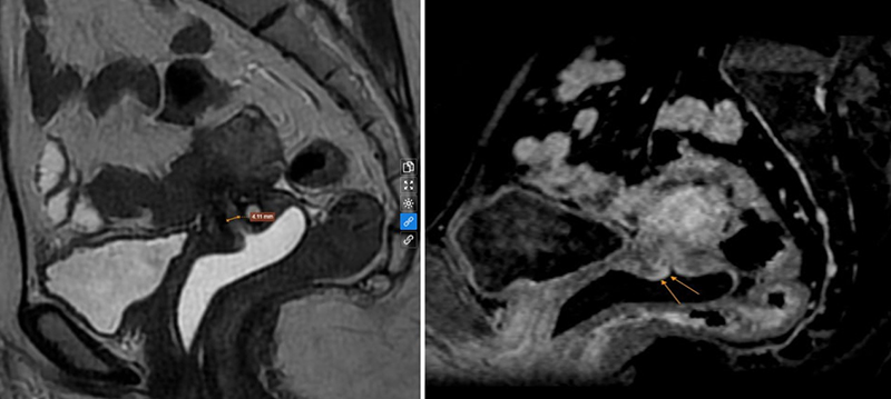 Kết quả MRI tiểu khung cho thấy bệnh nhân mắc K CTC giai đoạn IA