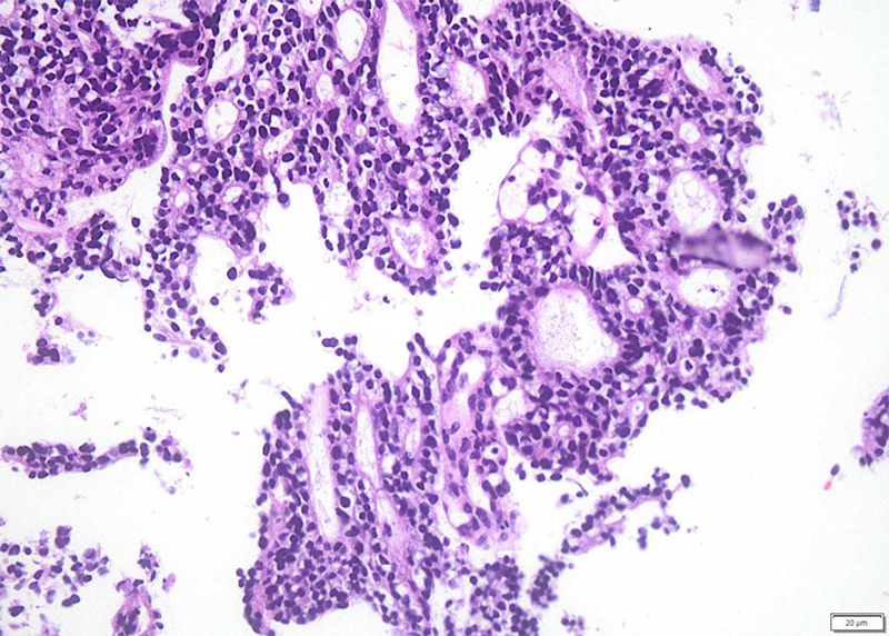 Giải phẫu bệnh sinh thiết cổ tử cung cho kết quả Carcinoma tuyến cổ tử cung