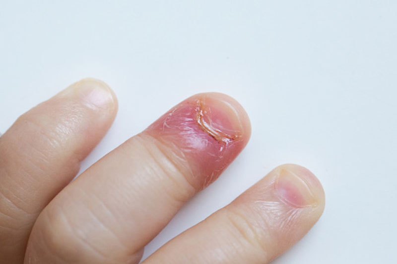 Cắn móng tay là nguyên nhân phổ biến dẫn đến nhiễm trùng móng