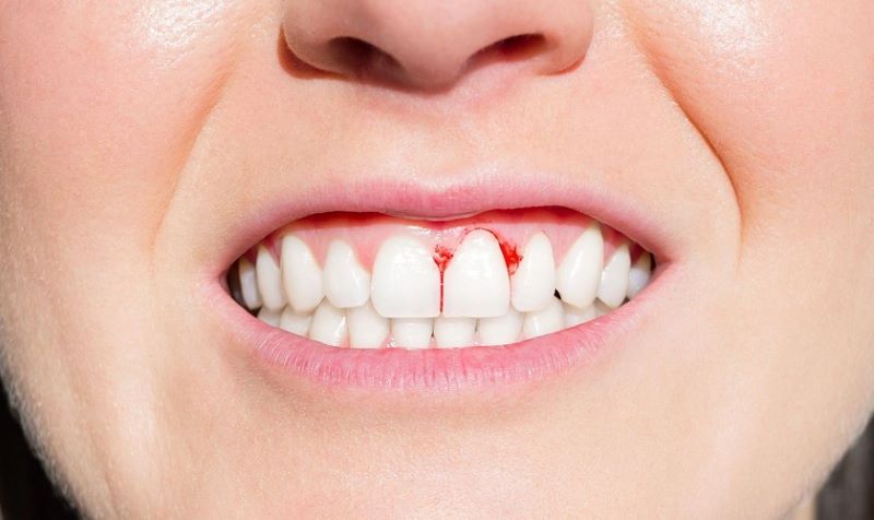 Rutin C thường được dùng với người hay bị chảy máu chân răng