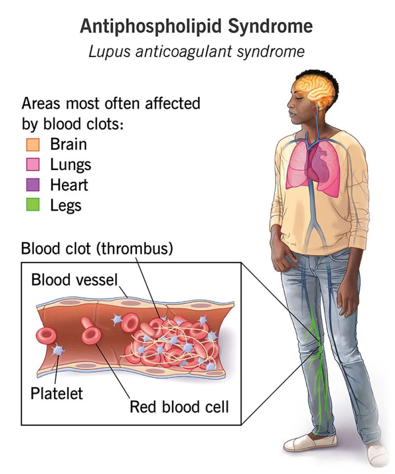 Kháng thể kháng phospholipid APLs làm cản trở quá trình đông máu