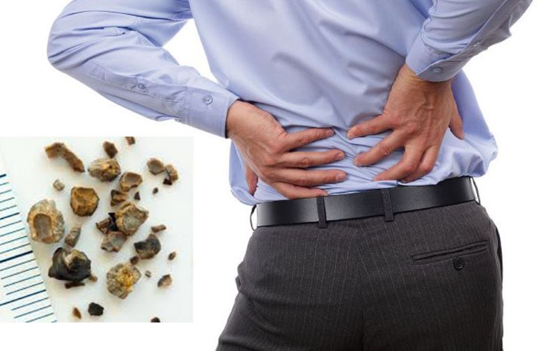 Đau hố thắt lưng, vùng hông là triệu chứng điển hình khi bị sỏi tiết niệu