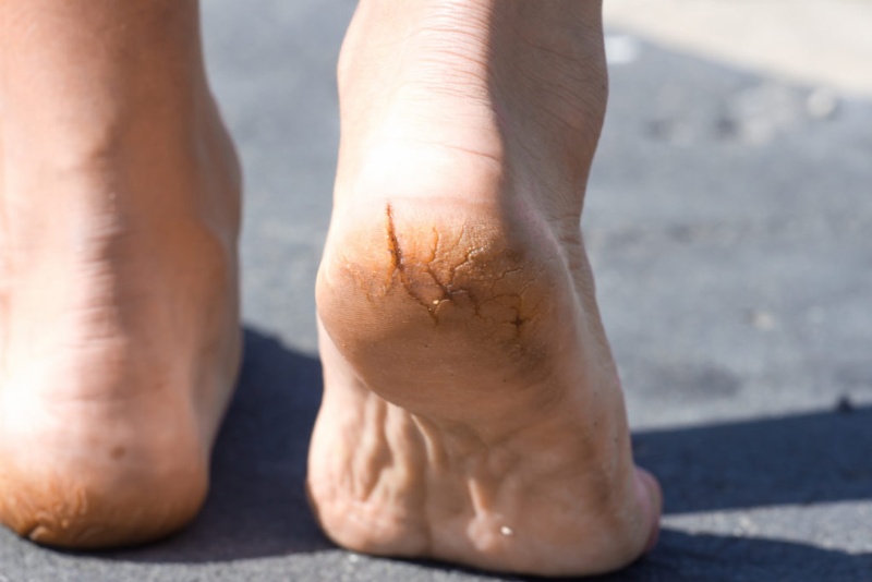 Cách chữa  gót chân bị nứt chảy máu  hiệu quả