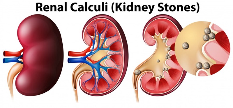 Sỏi thận có thể gây biến chứng nghiêm trọng