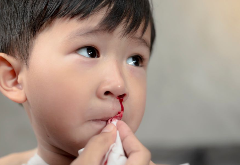 Chảy máu mũi trước xảy ra phổ biến hơn nhưng ít nguy hiểm