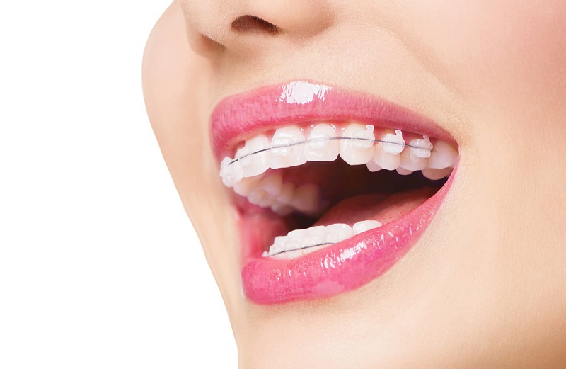 Lựa chọn địa chỉ niềng răng có vai trò quan trọng đối với hiệu quả thẩm mỹ đạt được sau khi chỉnh nha 