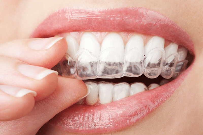 Niềng răng là quy trình chỉnh nha giúp đưa răng trở về vị trí bị sai lệch để có hàm răng đều đẹp