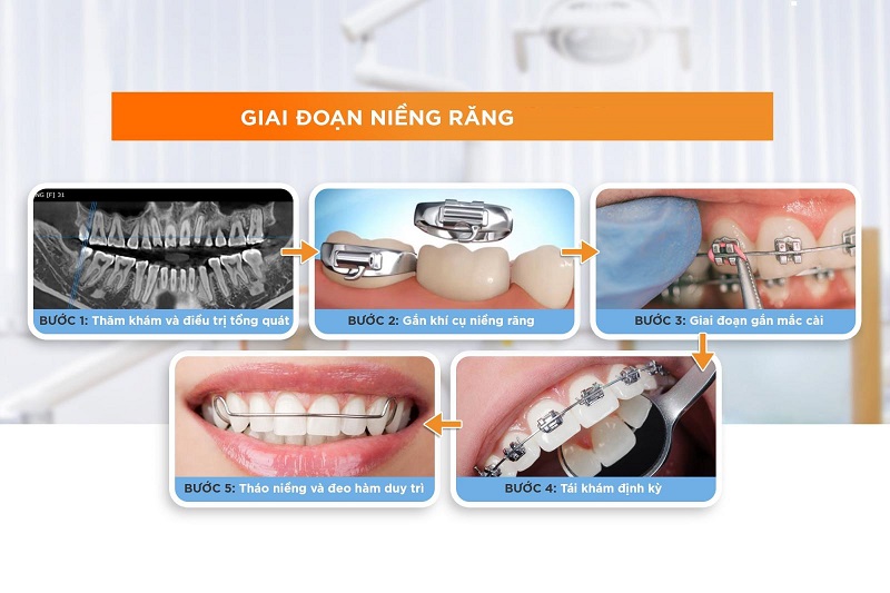 Các giai đoạn niềng răng cơ bản mà hầu hết các phương pháp niềng đều trải qua