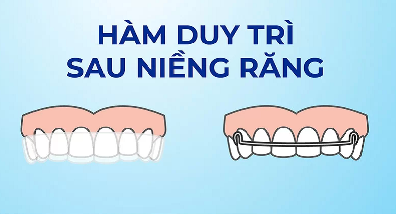 Sau khi tháo niềng cần tuân thủ hướng dẫn về đeo hàm duy trì từ nha sĩ để có được kết quả niềng răng tốt nhất