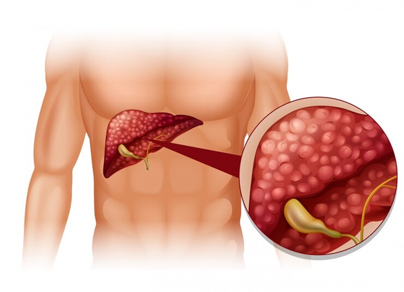 SGOT tăng có thể do bệnh về gan