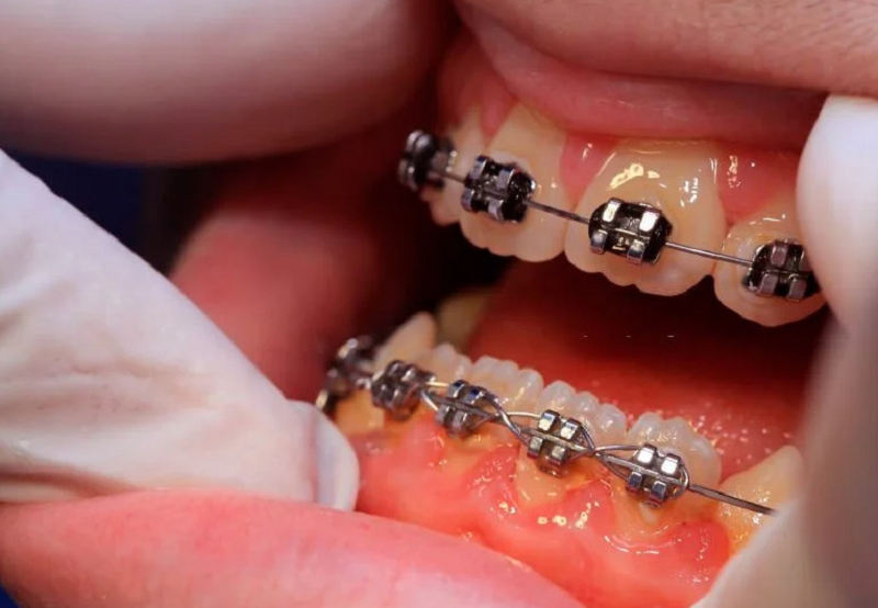 Viêm nướu là một trong những tác hại của niềng răng sai kỹ thuật và vệ sinh răng miệng kém