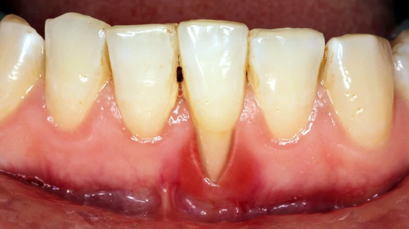 Niềng răng không được chăm sóc kỹ càng có thể bị tiêu xương răng