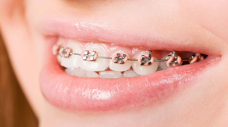 Niềng răng 1 hàm chỉ nên áp dụng với một số đối tượng nhất định